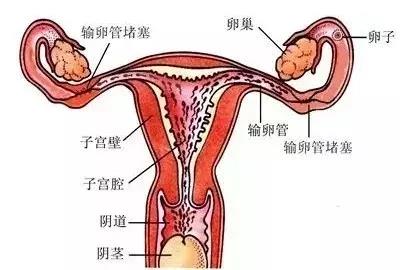 输卵管不通造成不孕？竟然这些原因造成